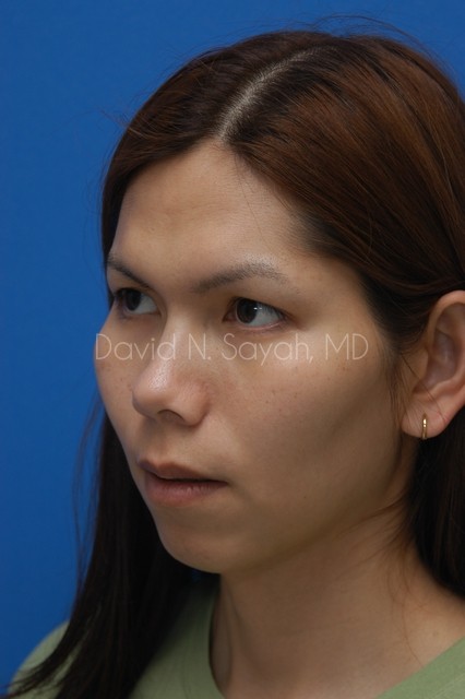 Chin Implant Before and After | Sayah Institute