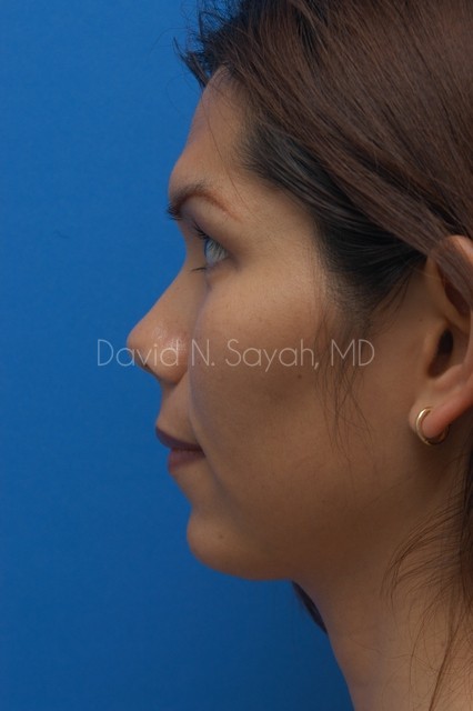 Chin Implant Before and After | Sayah Institute