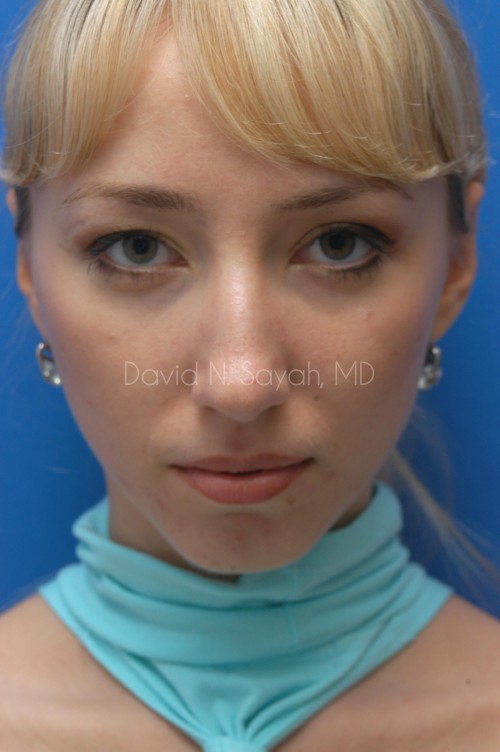 Chin Implant Before and After | Sayah Institute