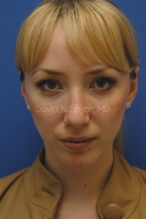 Chin Implant Before and After | Sayah Institute