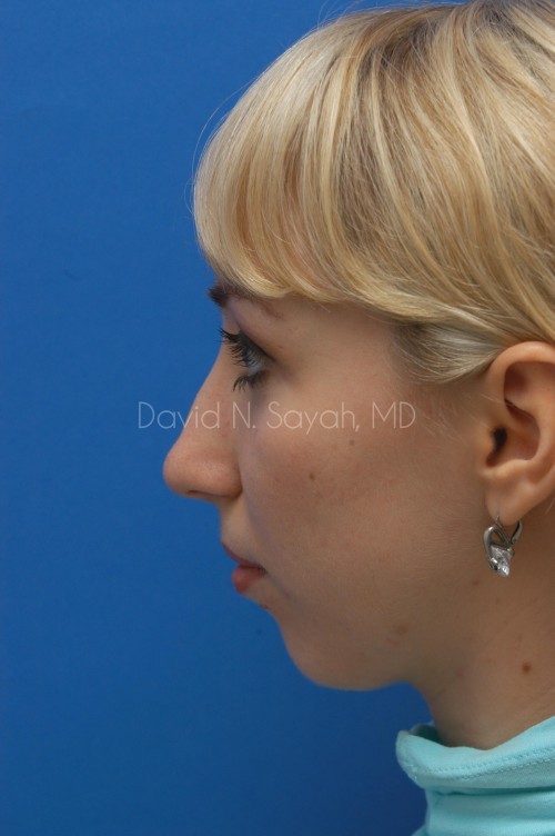 Chin Implant Before and After | Sayah Institute