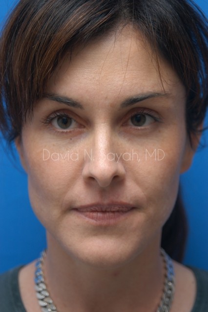 Chin Implant Before and After | Sayah Institute