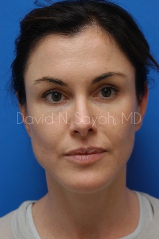 Chin Implant Before and After | Sayah Institute