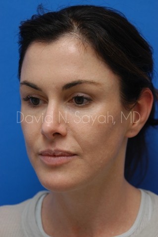 Chin Implant Before and After | Sayah Institute