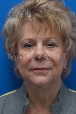 Chin Implant Before and After | Sayah Institute