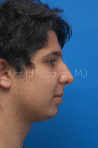 Chin Implant Before and After | Sayah Institute