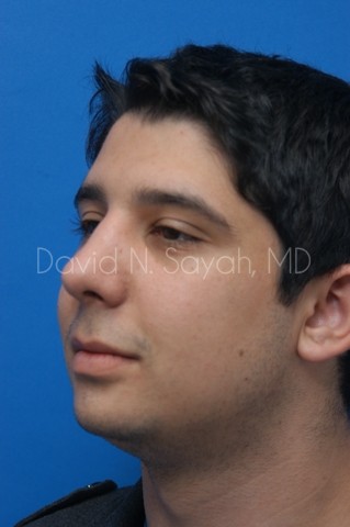 Chin Implant Before and After | Sayah Institute