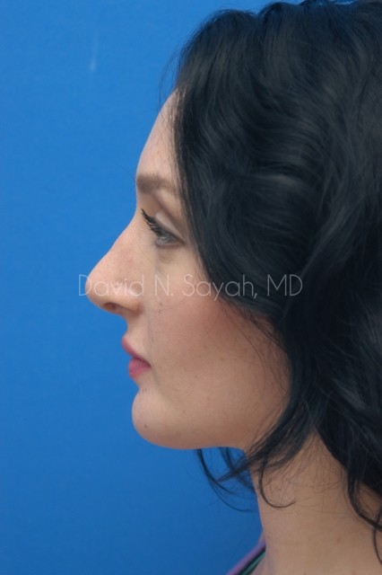 Chin Implant Before and After | Sayah Institute