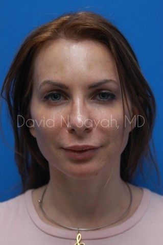 Chin Implant Before and After | Sayah Institute