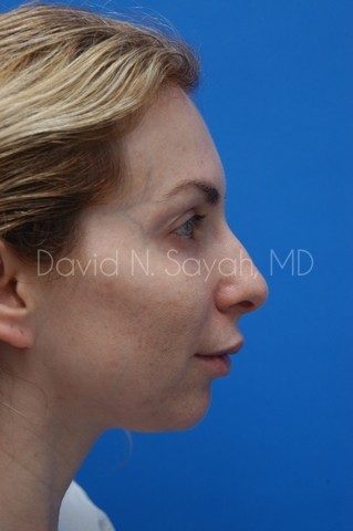 Chin Implant Before and After | Sayah Institute