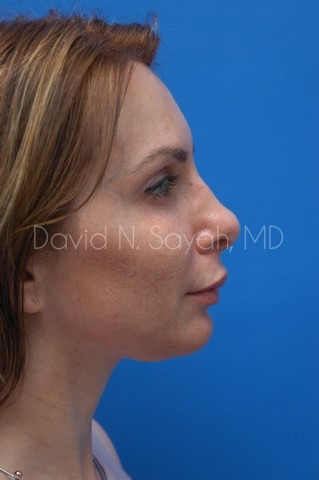 Chin Implant Before and After | Sayah Institute