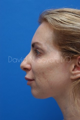 Chin Implant Before and After | Sayah Institute