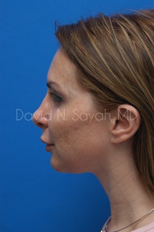 Chin Implant Before and After | Sayah Institute