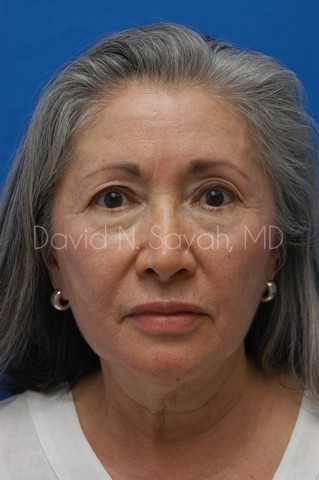 Chin Implant Before and After | Sayah Institute