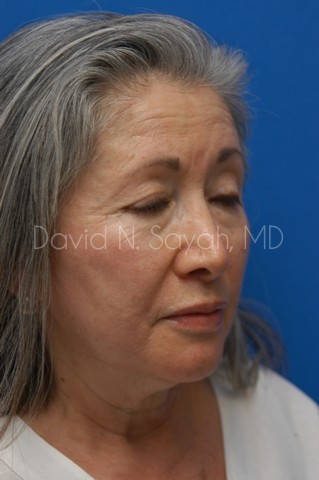 Chin Implant Before and After | Sayah Institute