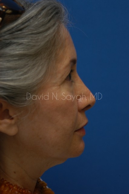 Chin Implant Before and After | Sayah Institute