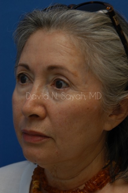 Chin Implant Before and After | Sayah Institute