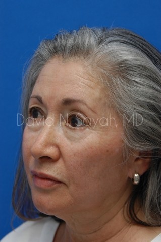 Chin Implant Before and After | Sayah Institute