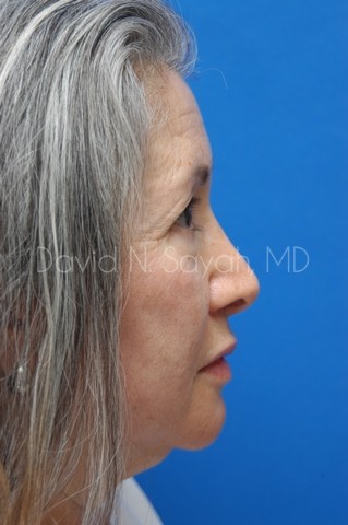 Chin Implant Before and After | Sayah Institute