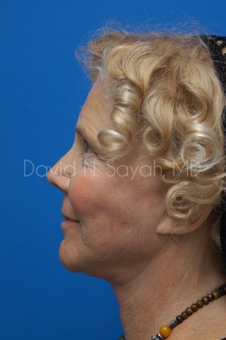 Co2 Laser Before and After | Sayah Institute
