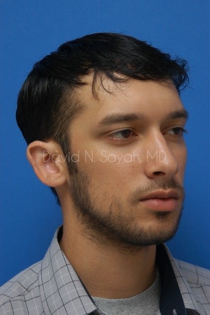Ear Surgery Before and After | Sayah Institute
