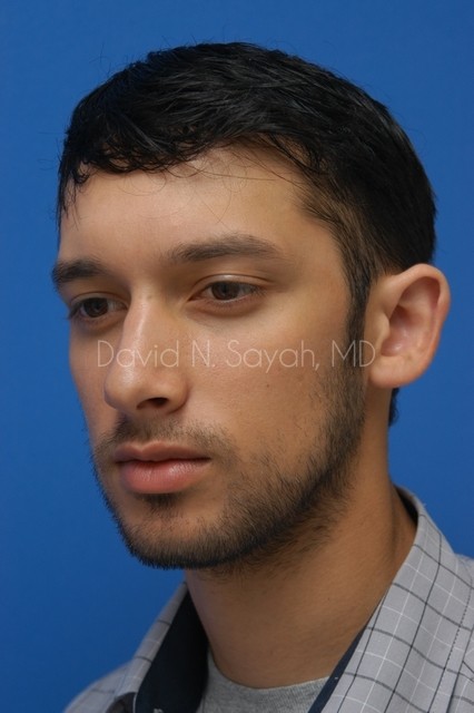 Ear Surgery Before and After | Sayah Institute