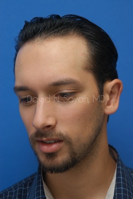 Ear Surgery Before and After | Sayah Institute