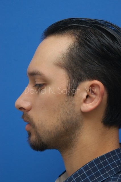 Ear Surgery Before and After | Sayah Institute