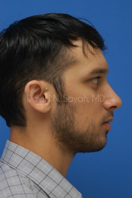 Ear Surgery Before and After | Sayah Institute
