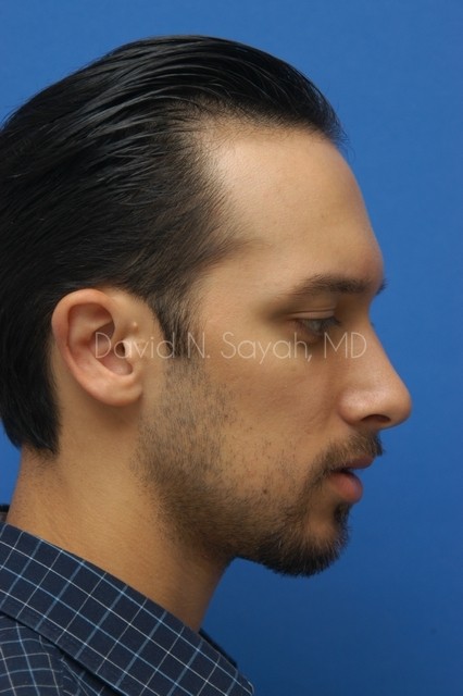 Ear Surgery Before and After | Sayah Institute