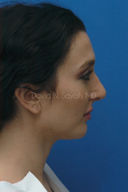 Ear Surgery Before and After | Sayah Institute