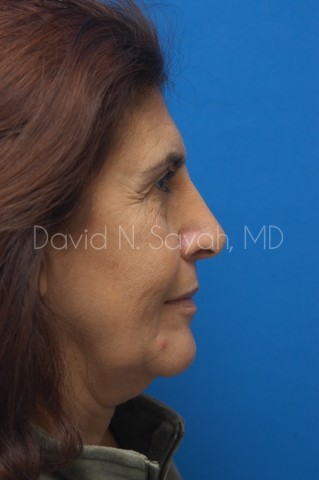 Endoscopic Brow Lift Before and After | Sayah Institute