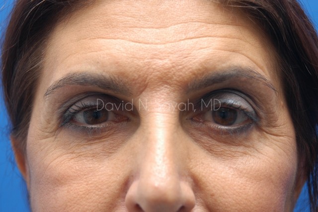 Endoscopic Brow Lift Before and After | Sayah Institute