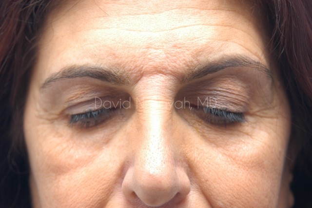 Endoscopic Brow Lift Before and After | Sayah Institute