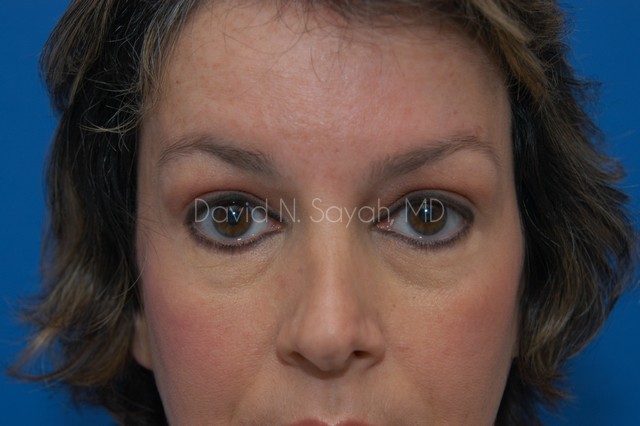 Endoscopic Brow Lift Before and After | Sayah Institute