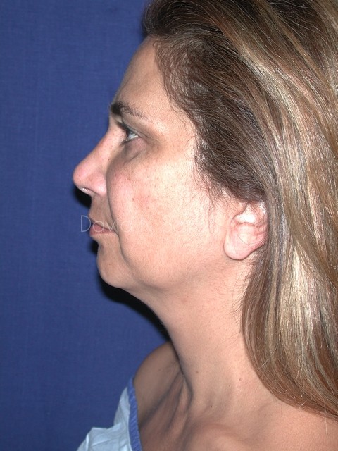 Endoscopic Facelift Before and After | Sayah Institute