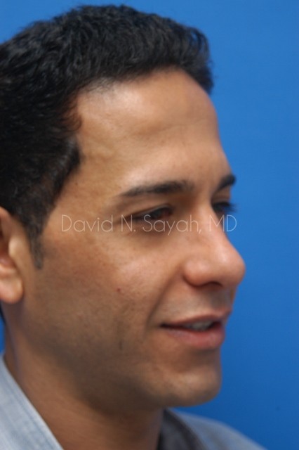 Eyelid Surgery Before and After | Sayah Institute