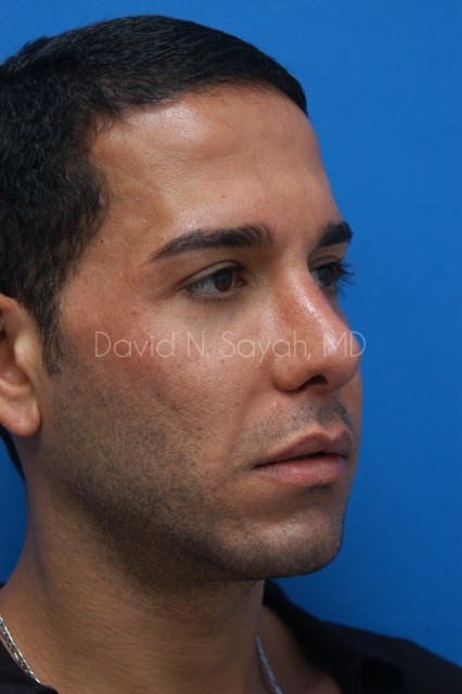 Eyelid Surgery Before and After | Sayah Institute