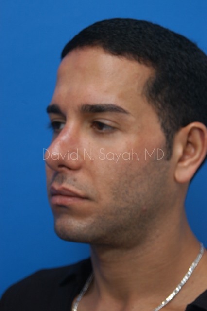 Eyelid Surgery Before and After | Sayah Institute
