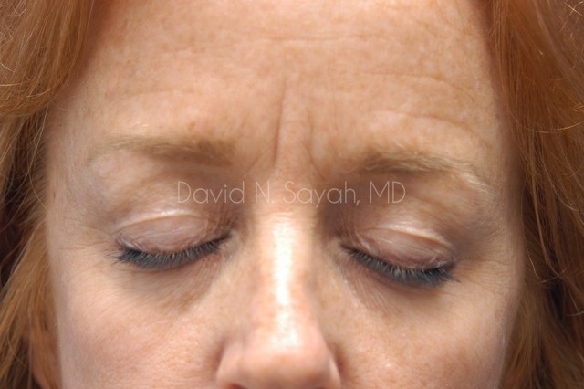 Eyelid Surgery Before and After | Sayah Institute