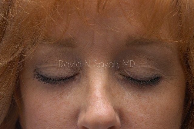 Eyelid Surgery Before and After | Sayah Institute