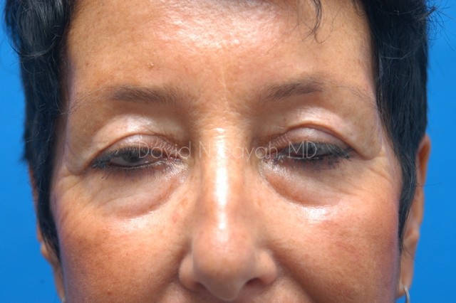 Eyelid Surgery Before and After | Sayah Institute