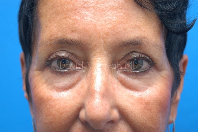 Eyelid Surgery Before and After | Sayah Institute