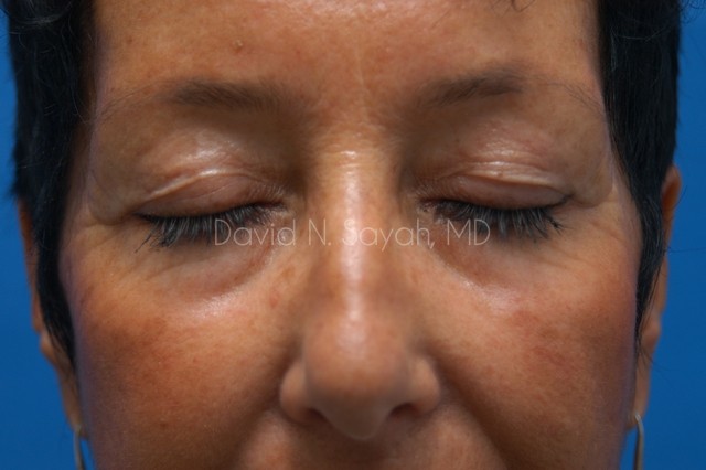 Eyelid Surgery Before and After | Sayah Institute