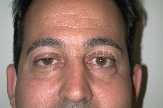 Eyelid Surgery Before and After | Sayah Institute