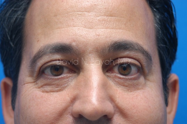 Eyelid Surgery Before and After | Sayah Institute