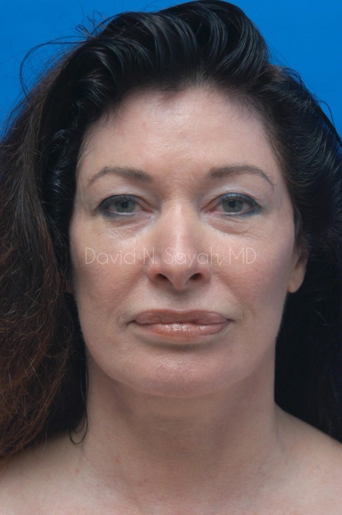 Facelift Before and After | Sayah Institute