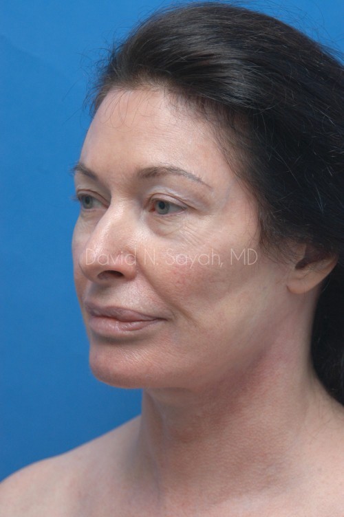Facelift Before and After | Sayah Institute