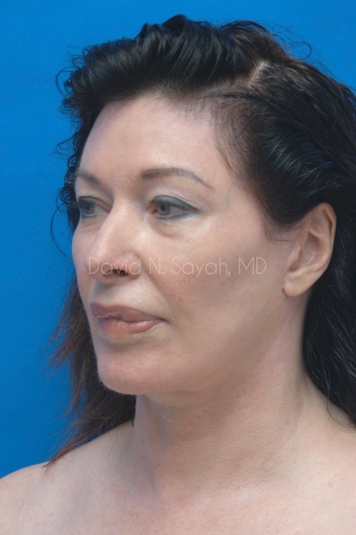 Facelift Before and After | Sayah Institute