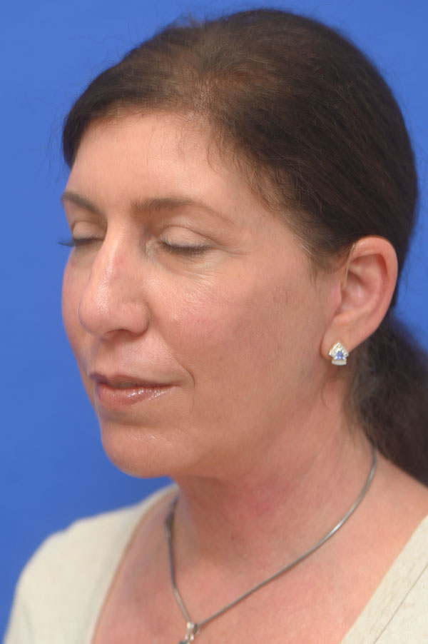 Facelift Before and After | Sayah Institute